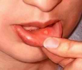 24 Home Remedies For Canker Sores